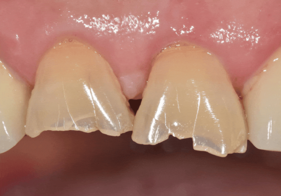 Godeok-dong Tooth Fracture: Check This Before Getting an Implant! Revealing the Criteria for Saving It image 7