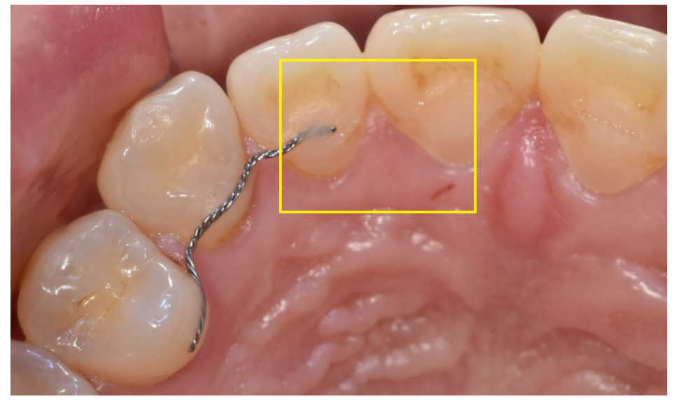 Two Types of Retainers Are Needed After Orthodontic Treatment: Bonded and Removable image 3