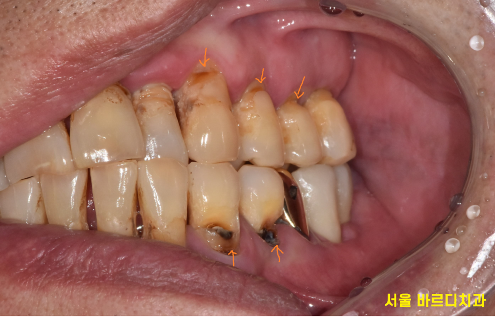 녹아버린 잇몸뼈 흔들리는 여러 치아 발치 후 임플란트 시행 관련 이미지 4