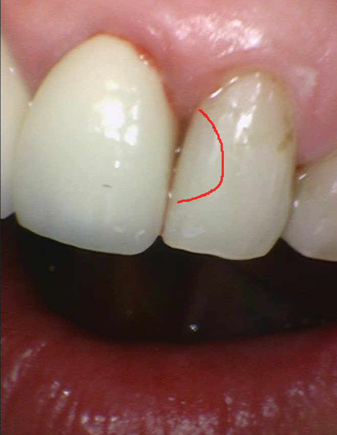 미사역 치과 앞니 충치 레진으로 당일 수복 완료하였습니다. 관련 이미지 6