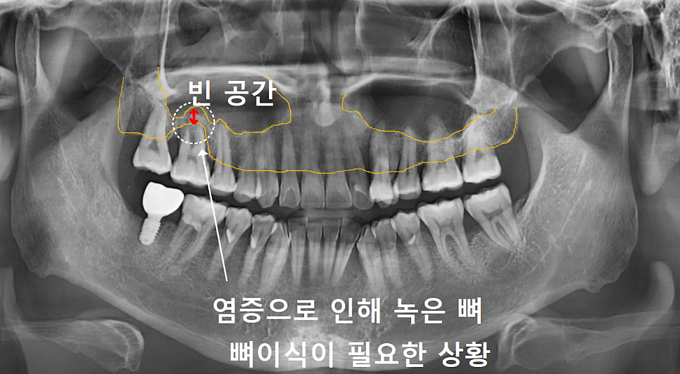 보험 임플란트 비용, 왜 치과마다 이렇게 다를까? 관련 이미지 3