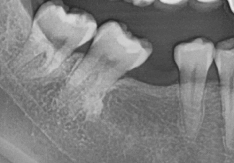 No space for an implant because a tooth has fallen over or a molar has tilted? Read this first. image 14