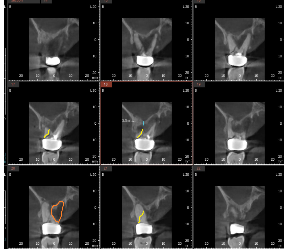 망월동 치과 염증이 심하면 임플란트 바로 못심어요 잇몸뼈 함몰 케이스 관련 이미지 3