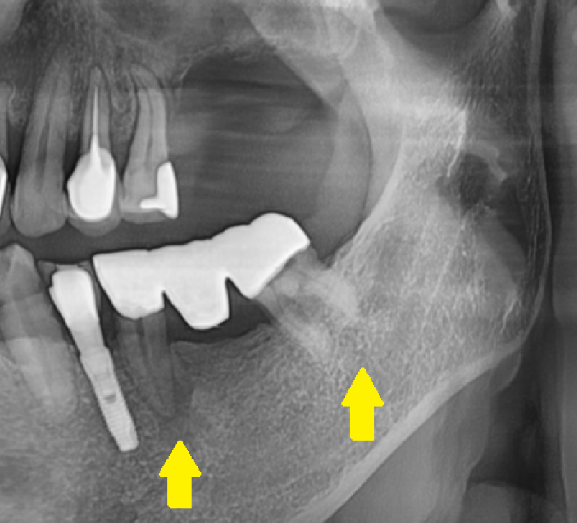 치아 상실 치료 치과 브릿지? 임플란트? 무엇이든 시도하세요. 관련 이미지 6