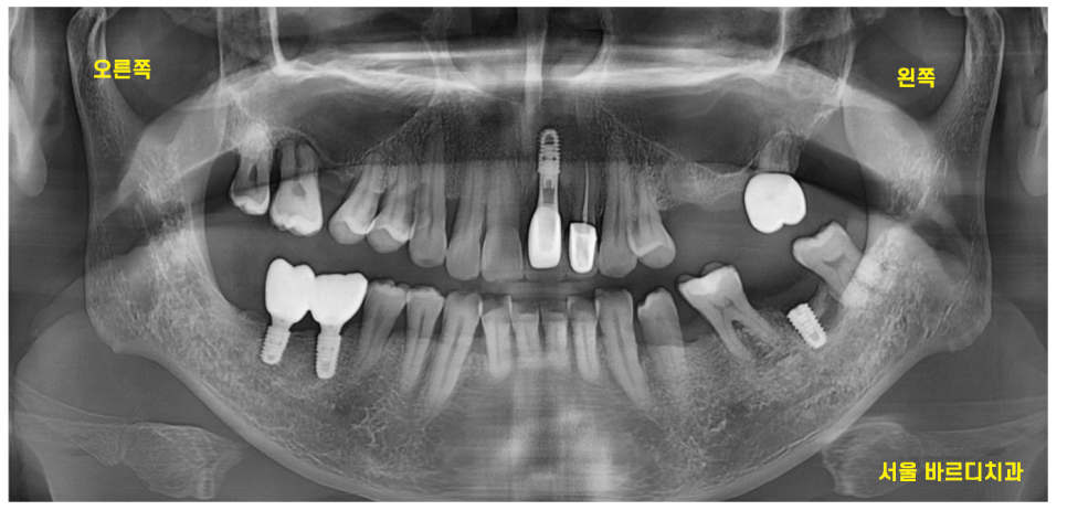 상일동 임플란트 상악동 거상술을 동반한 수술 증례 관련 이미지 1