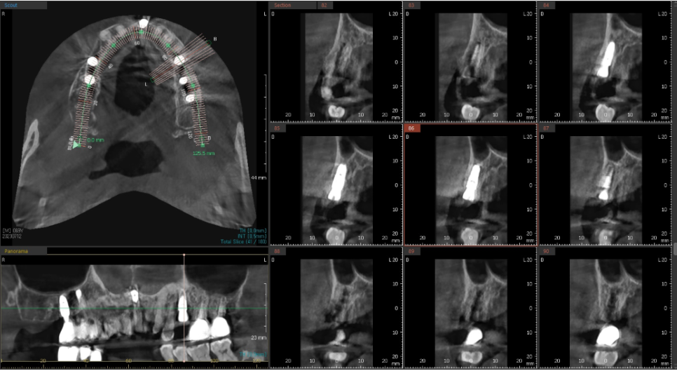 고덕동치과 서울바르디치과 전치부 및 구치부 임플란트 치료증례 #10 관련 이미지 12