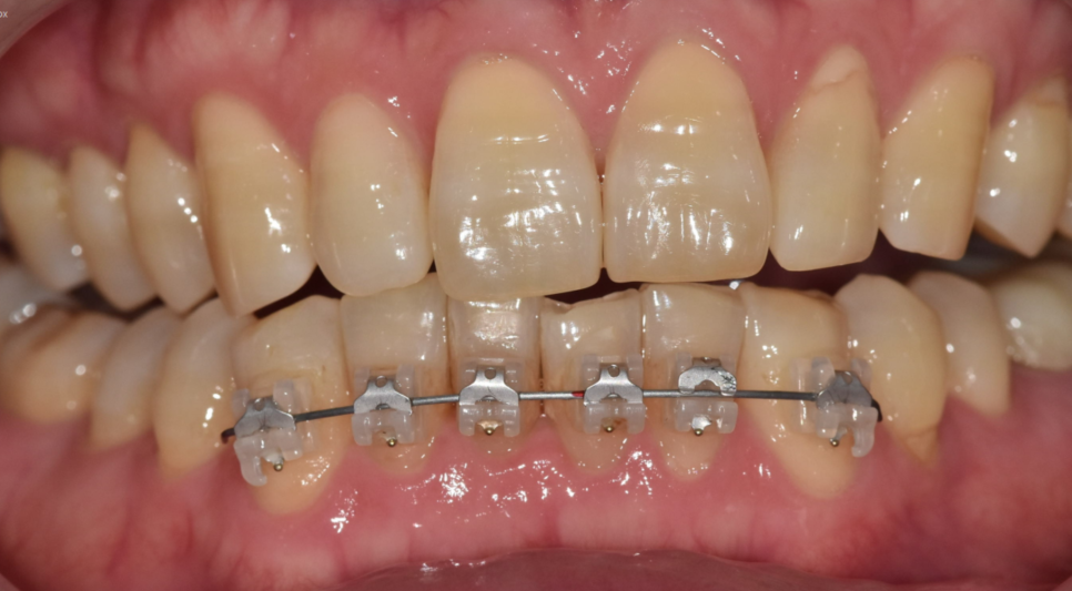 The Moment You Decide on Orthodontic Treatment in Your 50s Is the Fastest image 6