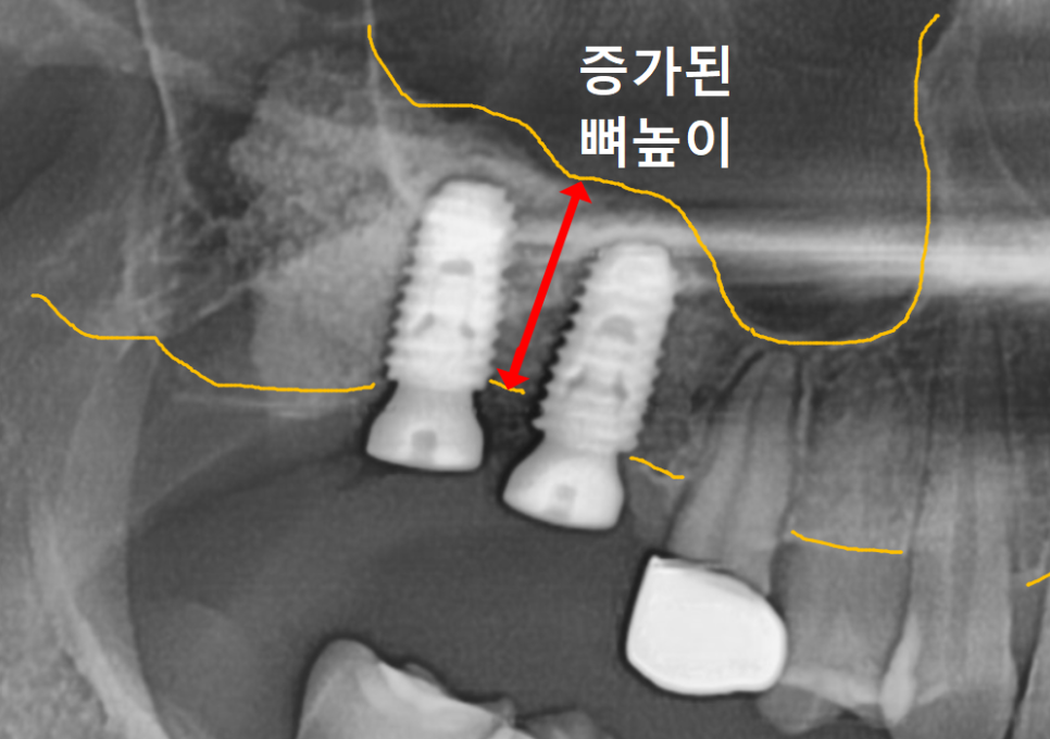 Myeongil-dong Implant Treatment in Your 20s: The Reason It Ended Up Requiring Bone Grafting After Thinking, “I’m Young, So It’ll Be Fine” image 11