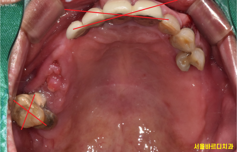 천호동 치과 자연 발치 후 방치된 치아 임플란트 케이스 관련 이미지 3