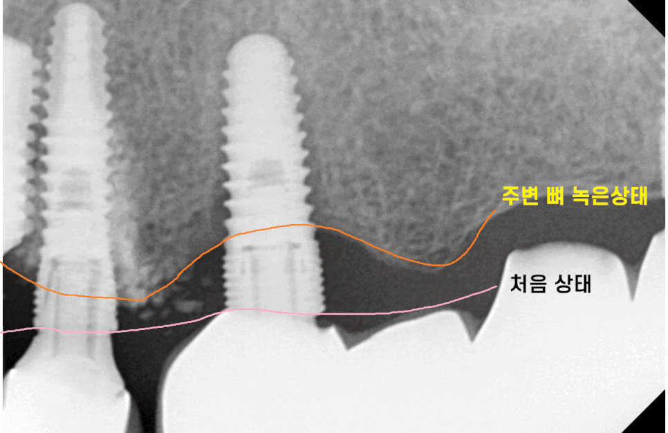 임플란트 잇몸 염증 반복되면 재수술도 필요합니다. 관련 이미지 1