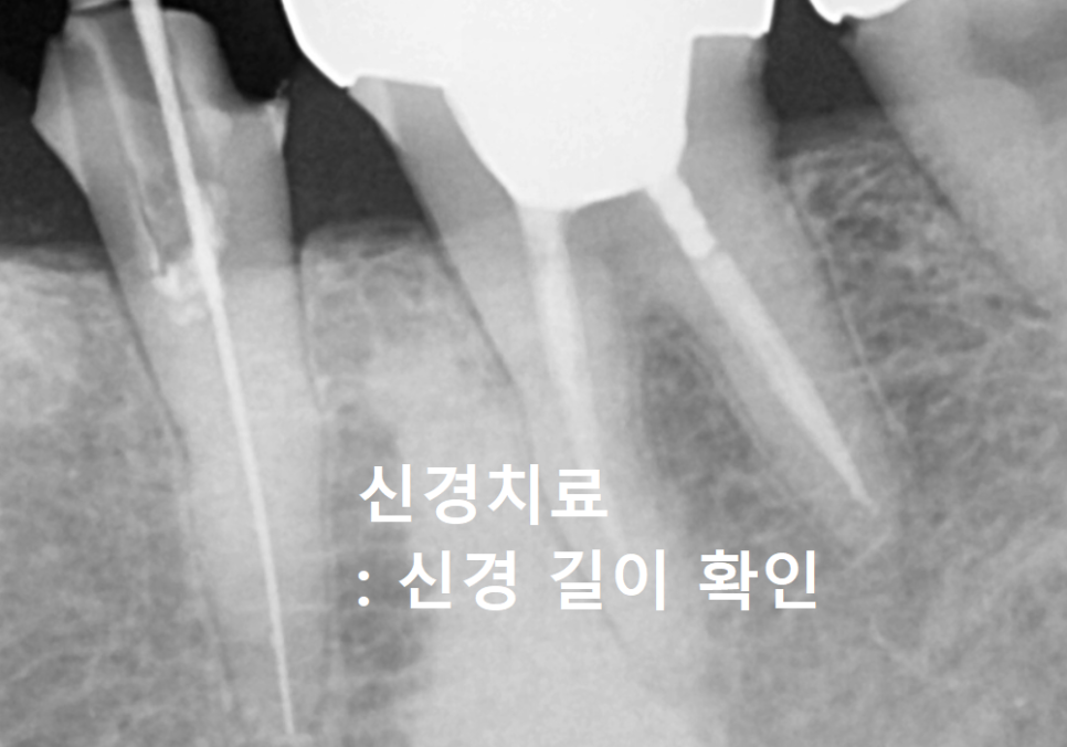 아말감 파절, 조금 깨졌을 뿐인데, 2차 충치로 치아 절반이 깨진 사연 관련 이미지 6