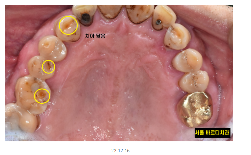 강일동 치과추천 어금니 시림 방치하다 발치하고 임플란트 하신 사연 관련 이미지 3