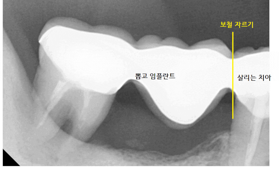 강일역 치과 치아와 임플란트 연결 가능한가요??? 관련 이미지 1
