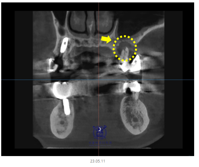 미사 임플란트 70대 연령과 상관없는 치료 과정 관련 이미지 5