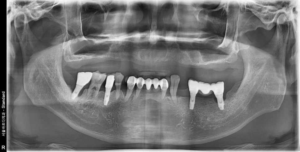 얇은 잇몸뼈, 임플란트 거부 당했다면? 상악동거상술로 해결할 수 있습니다. 관련 이미지 17
