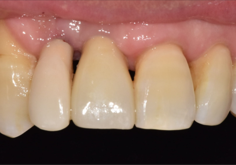 앞니 임플란트, 원내 기공소의 중요성을 아시나요? 관련 이미지 20