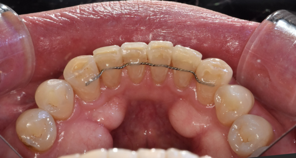 Two Types of Retainers Are Needed After Orthodontic Treatment: Bonded and Removable image 2