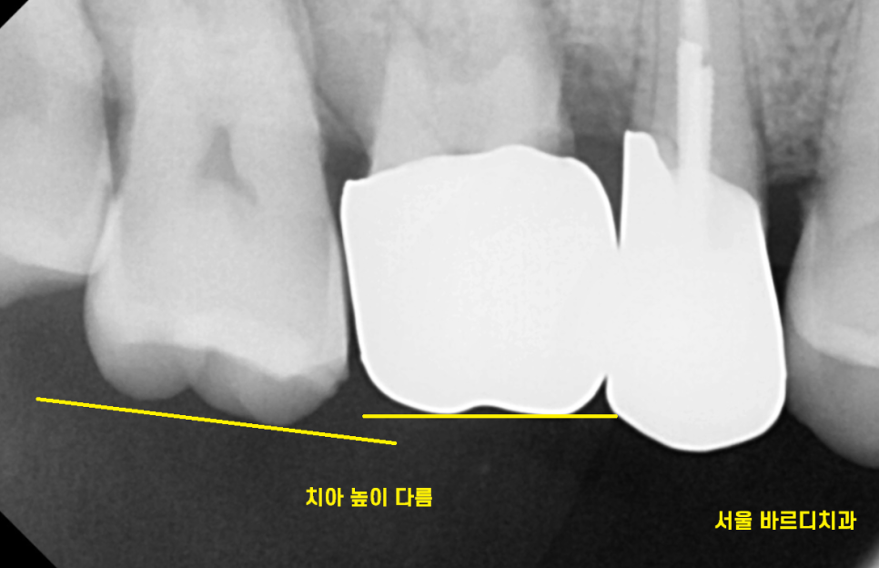 상일동 임플란트 치아 솟음으로 불편함을 느낄 때 관련 이미지 4