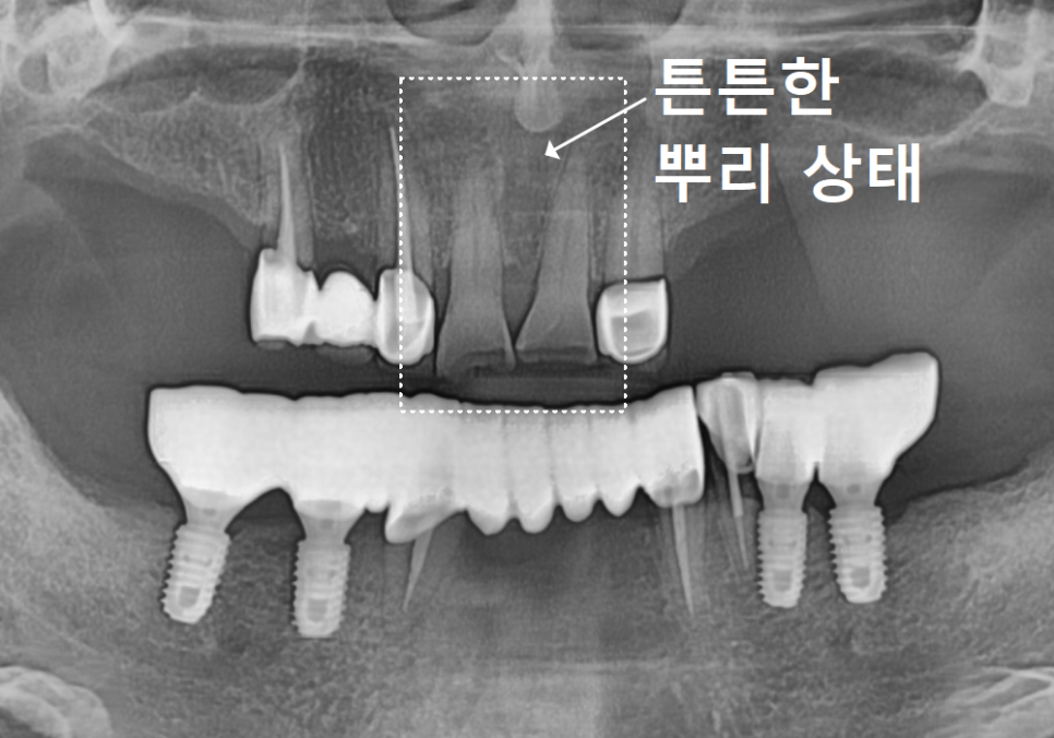 Godeok-dong Tooth Fracture: Check This Before Getting an Implant! Revealing the Criteria for Saving It image 5