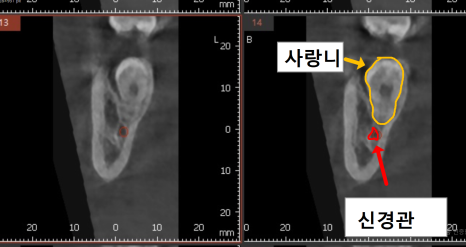 상일동 사랑니 매복 방치하다 옆 치아까지 망가진 실제 사례 관련 이미지 8
