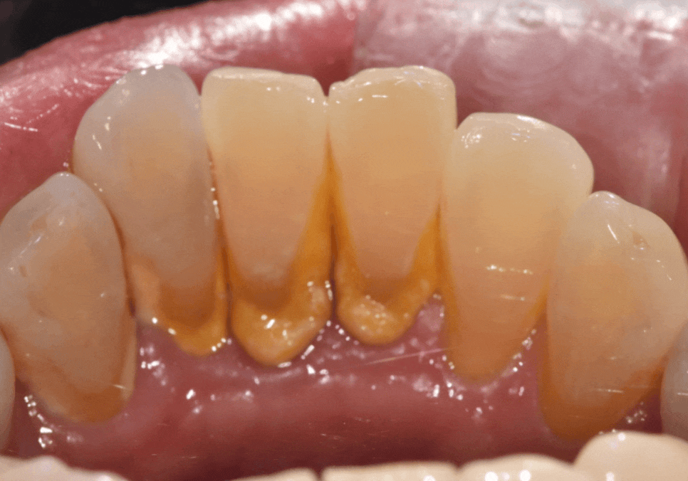 고덕동 아래 앞니 임플란트 비용 줄이는 비법, 공개합니다. 관련 이미지 5