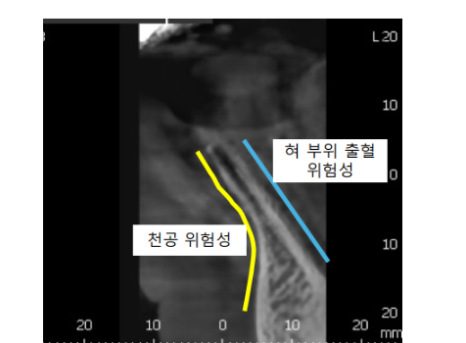 강동구 임플란트 수술 전 확인하면 좋을 3가지 관련 이미지 8