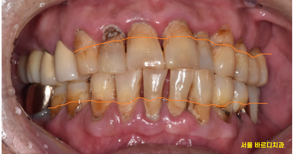 강일동 임플란트 위아래 치아 흔들림과 통증이 있을 때 방법은? 관련 이미지 3