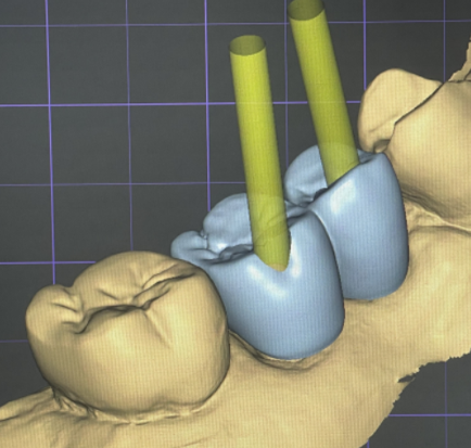 명일역 치과 보철 대표원장이 직접 제작합니다. 관련 이미지 6