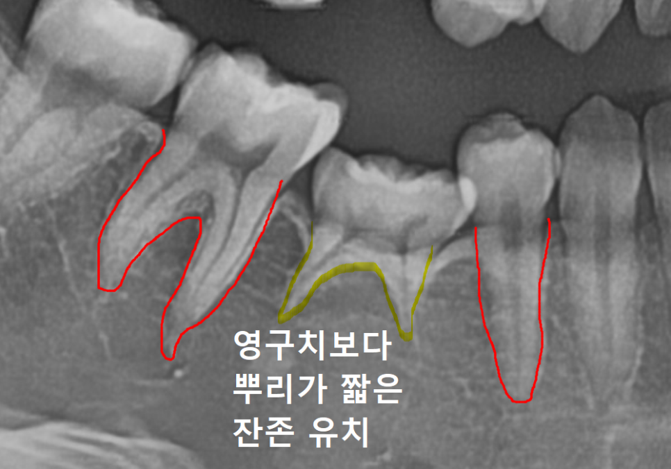 얇은 잇몸뼈 때문에 임플란트 하기 힘들다면? 저희는 관련 이미지 1