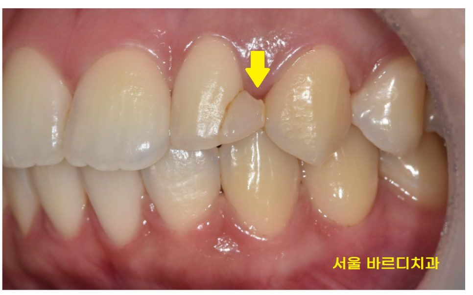 앞니 레진 변색으로 무삭제 라미네이트 진행했습니다. 관련 이미지 4