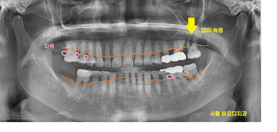 고덕동 치과 임플란트 거부감이 있었지만 네비게이션 수술법으로 해결했습니다. 관련 이미지 2