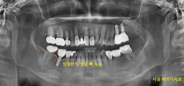 풍산동 치과 임플란트 염증으로 교체 한 환자분 케이스 관련 이미지 1