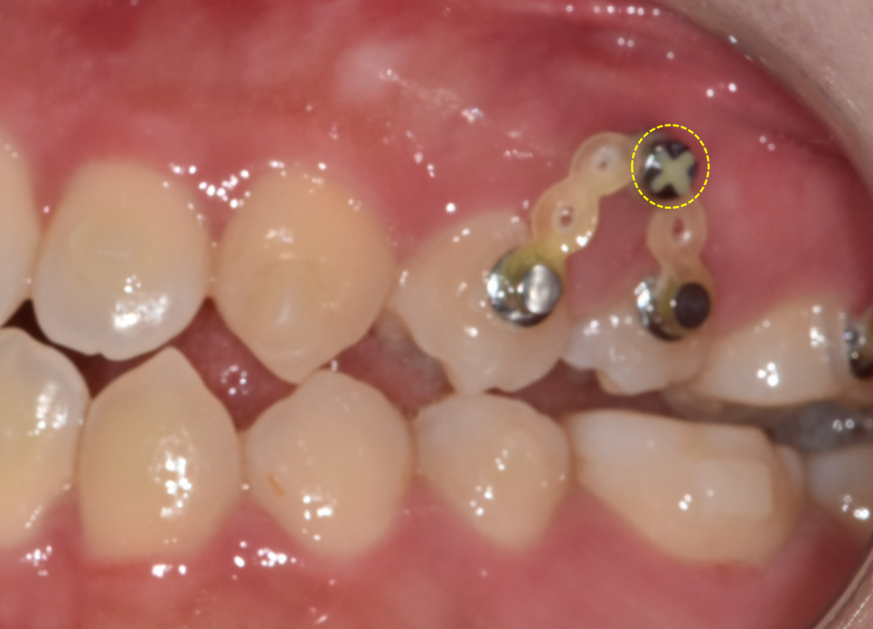 Answering Your Questions About Orthodontic Mini-Screw Placement. (Q&A) image 5
