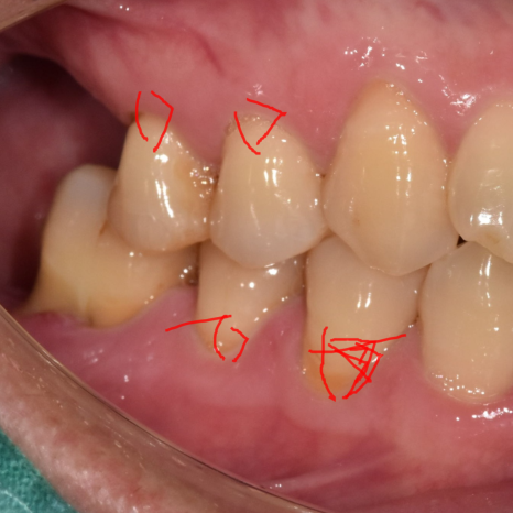 상일동역 임플란트 이 뽑고 임시틀니(플리퍼)는 꼭 해야 하나요? 관련 이미지 5