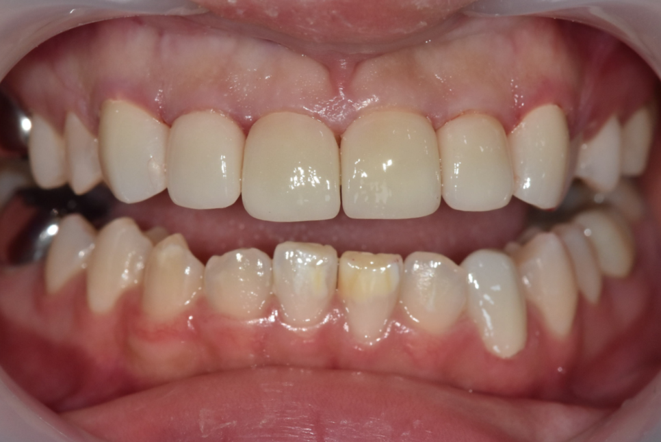 강동구 라미네이트, 치아 하얀 반점 없애고 싶다면? 치료 방법 관련 이미지 14