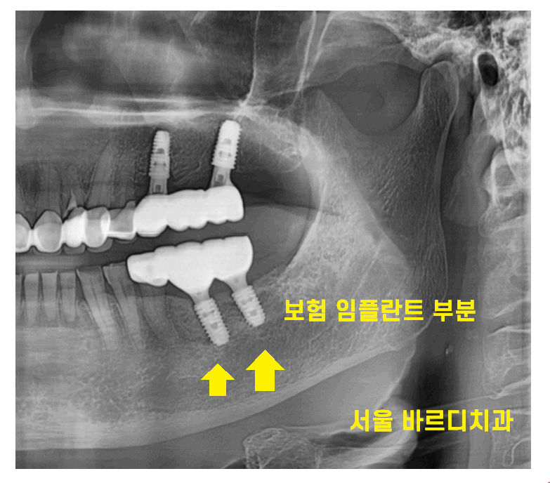 미사역 치과 건강보험 임플란트 혜택이 가능한 병원입니다. 관련 이미지 2
