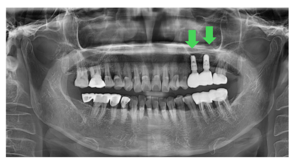 어금니 임플란트 1개 가격 왜이렇게 천차만별일까? 관련 이미지 2
