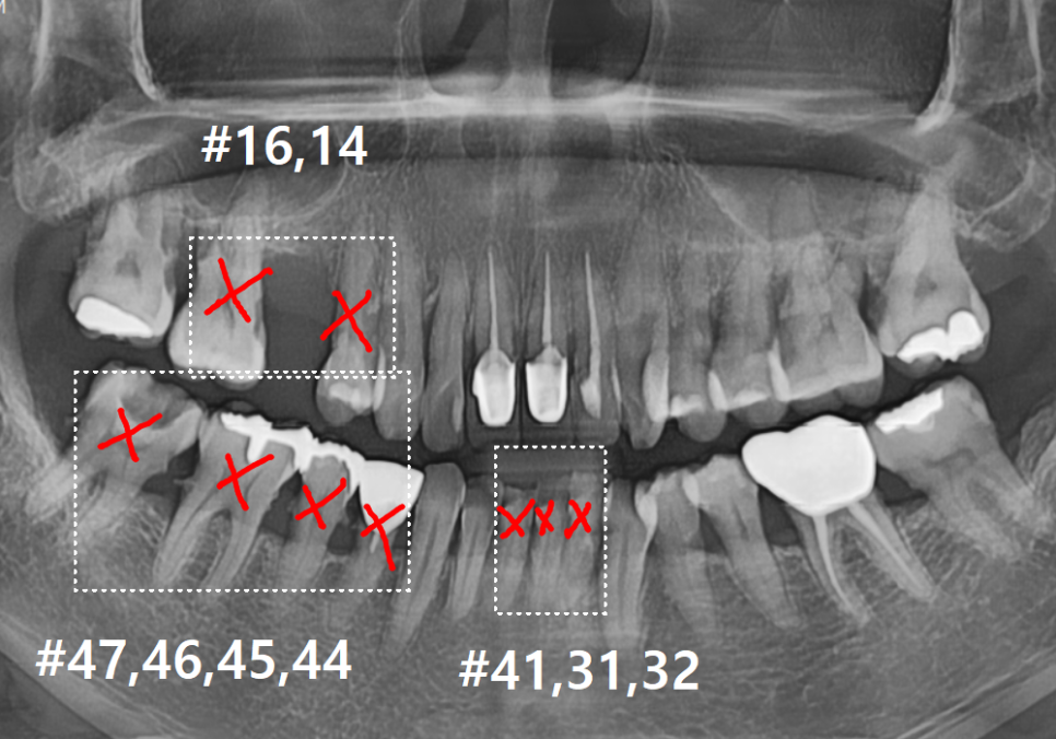 고덕동 스케일링 미루다 앞니 어금니 다 뽑고 임플란트 했습니다. 관련 이미지 15