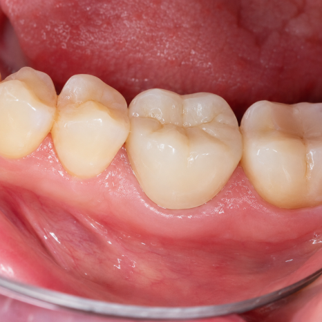Dental Implants image 3