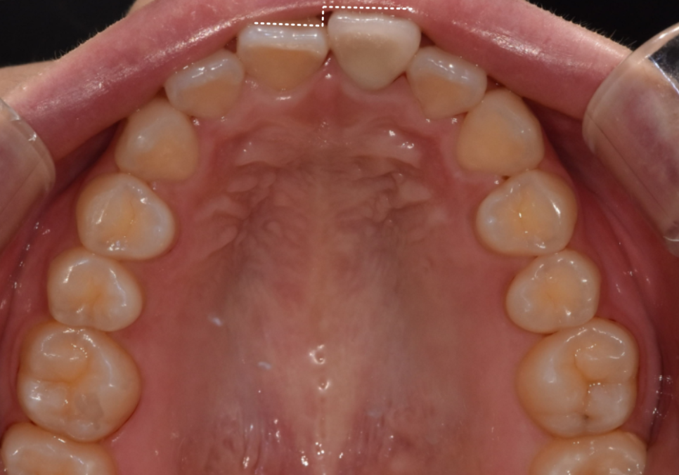 명일동 치과, 잇몸이 검게 변했다면? 앞니 변색 원인은 바로 관련 이미지 10
