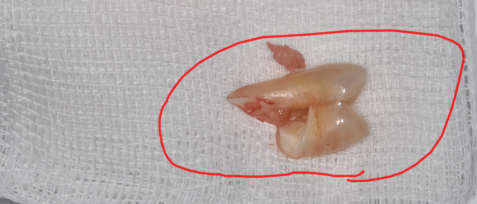 어금니 치아 파절 부러짐 발치까지 이어질 수 있습니다. 관련 이미지 6