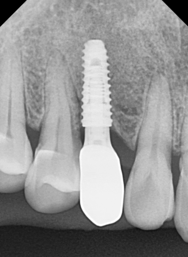 흔들리는 성인 잔존 유치, 50년 만에 송곳니 임플란트 하게 된 사연 관련 이미지 14