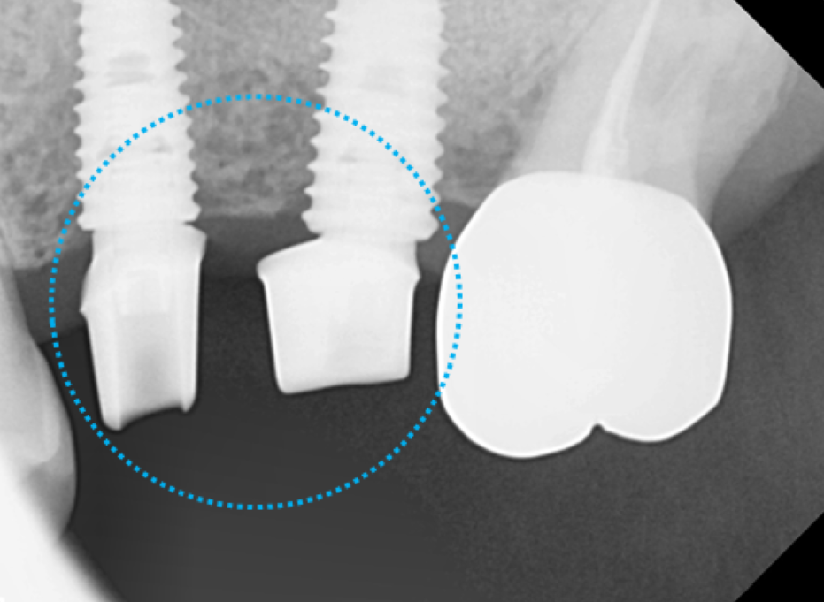 고덕동치과 서울바르디치과 전치부 및 구치부 임플란트 치료증례 #9 관련 이미지 36