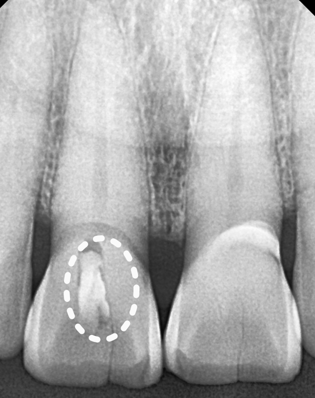 앞니 금 갔을 때, 방치하면 안 되는 진짜 이유 <파절 치료 사례> 관련 이미지 8