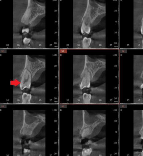 어금니 치아 파절 부러짐 발치까지 이어질 수 있습니다. 관련 이미지 8