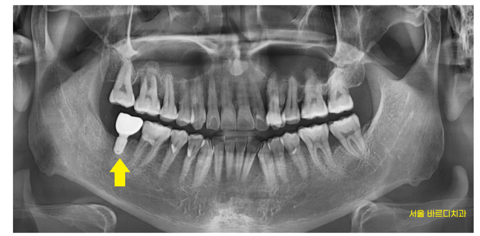 덕풍동 치과 잇몸 욱신 욱신 원인 찾아 임플란트 수술하였습니다. 관련 이미지 11