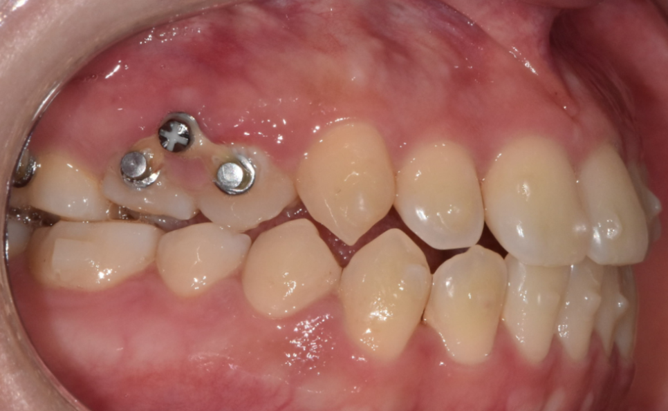 교정중 미니스크류 필수일까? 투명교정도 때로는 필요하다 관련 이미지 3