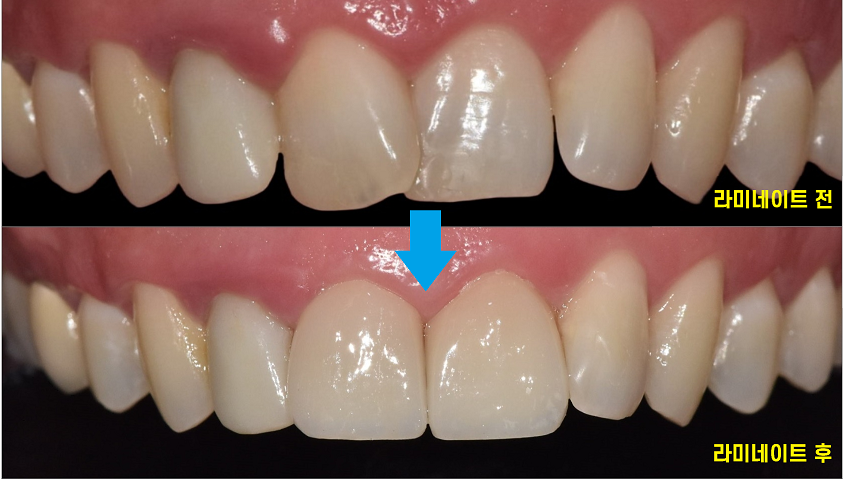 상일동 라미네이트 과연 진짜 안좋을까??? 교정, 크라운과 비교해보았습니다!! 관련 이미지 6