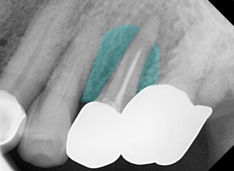 서울바르디치과 뿌리 끝 염증 심한 치아를 네비게이션 임플란트 #6 관련 이미지 3