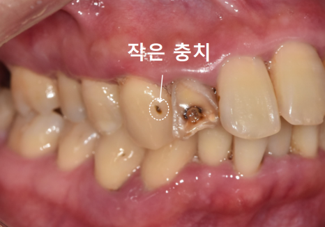 강동구 앞니 충치, 누구는 레진이고 누구는 임플란트인 관련 이미지 6